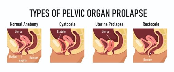 Blog Prolapse Types